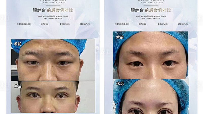 埋线提升与线雕：揭秘两者差异，选择更适合你的面部提升方案