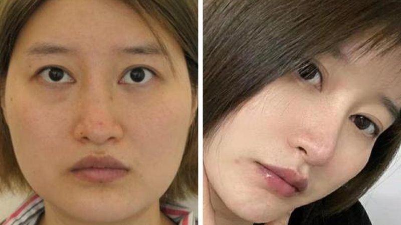 小标题：双眼皮修复，了解背后的原因