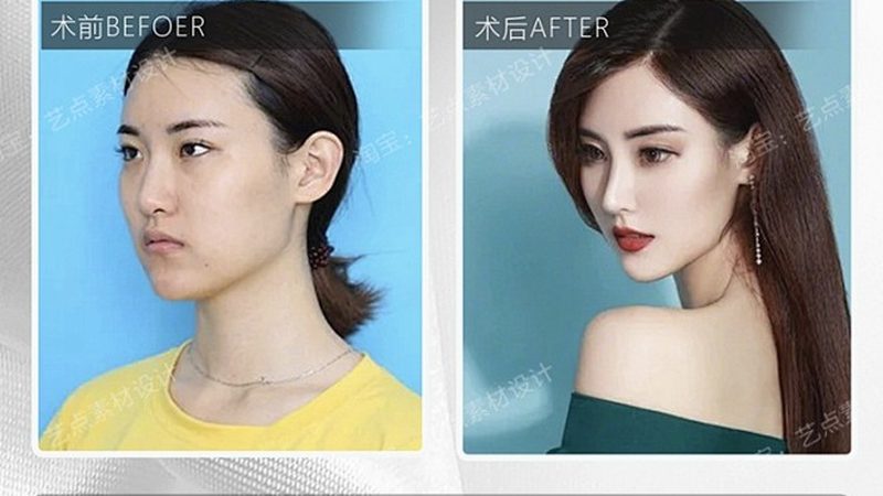 硅胶鼻综合整形：揭秘手术流程与注意事项**