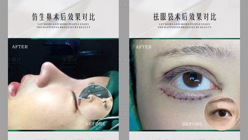 光子嫩肤与激光祛斑：黄褐斑治疗的最佳选择