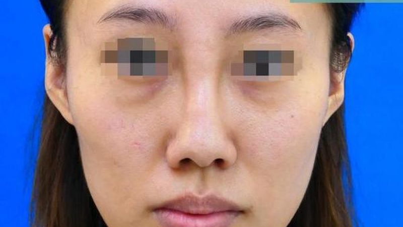 隆鼻手术风险大吗成都正规医院